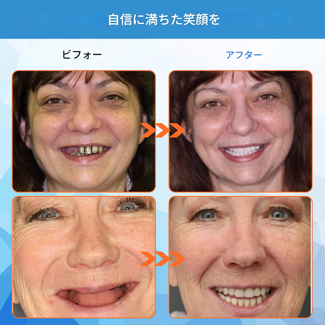 中高年向けセラミック義歯 – 抗菌・防汚仕様(⏰期間限定 – 80%オフ⏰)